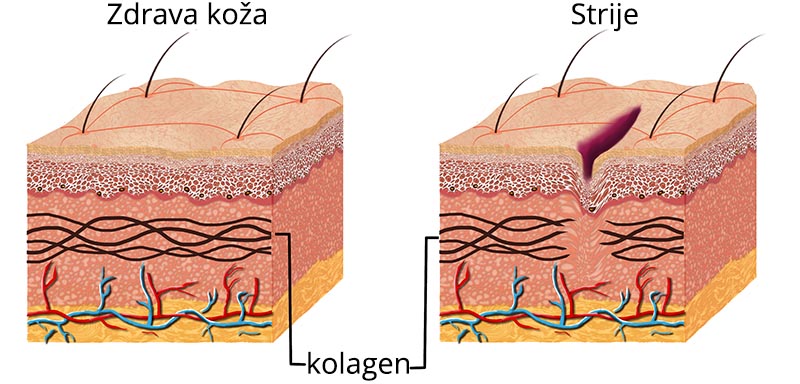 kolagen in strije